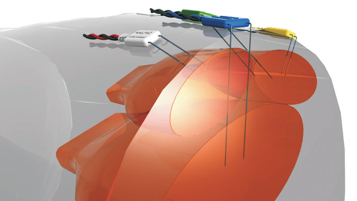 Intramuscolar Electrodes