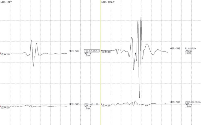 Intramuscolar Electrodes